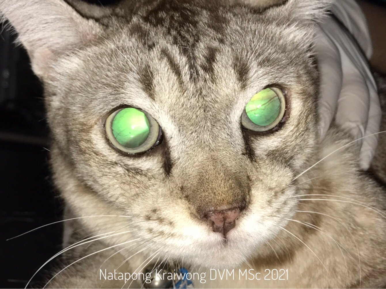 ความดันโลหิตสูงกับตาบอดเฉียบพลัน ความดันโลหิตสูงกับตาบอดเฉียบพลัน